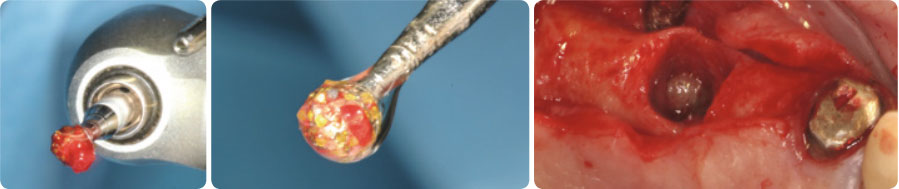 קיט דה-גרנולציה